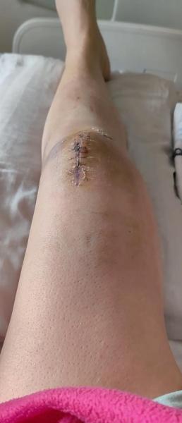 库卡隆术后膝盖僵硬，历经五次手术无奈退役